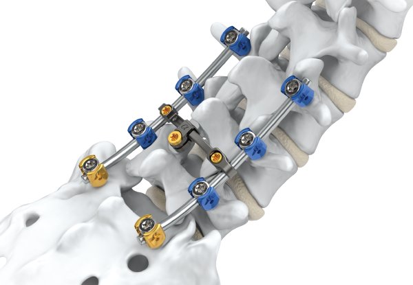 Spine Fixation Market With Manufacturing Process and CAGR Forecast by 2030